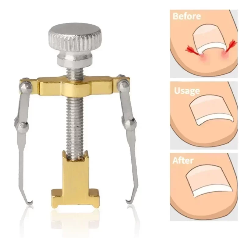 Rovnátko na zarostlý nehet z nerezové oceli | pomůcka pro pedikúru