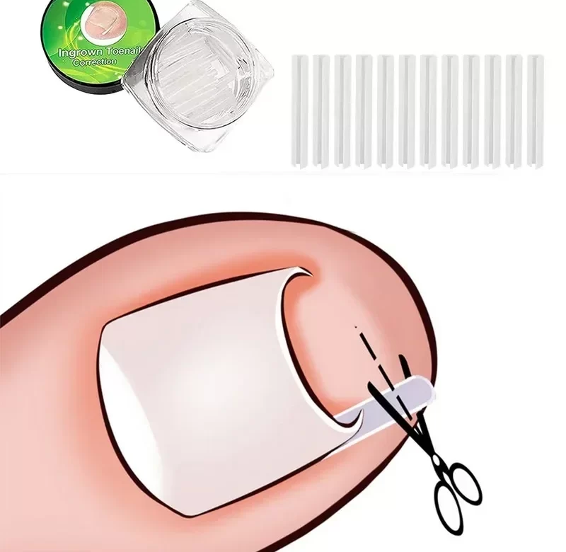 Náplast na zarůstající nehet | Sada na nehty, Pedikúra 10 ks