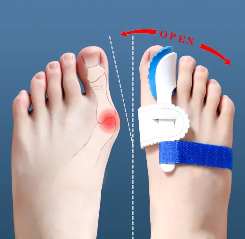 Oddělovač prstů proti vbočenému palci a bolesti | korektor, pomůcka